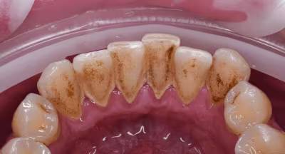 Before professional dental cleaning showing build-up near the gums